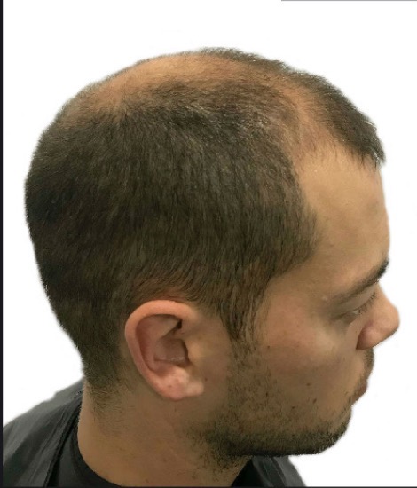 Before Sapphire FUE hair transplant