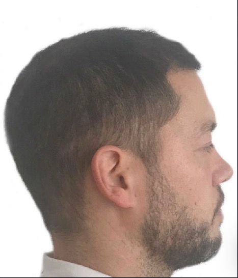 After Sapphire FUE hair transplant, twelve months result